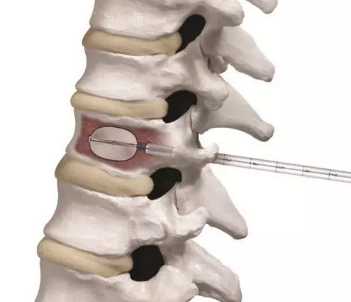 O que é um procedimento de discectomia e fusão cervical anterior? O que é um procedimento de discectomia e fusão cervical anterior?