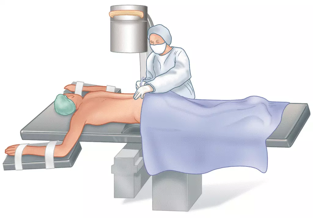 O que é uma fusão intersomática lombar posterior (PLIF)? O que é uma fusão intersomática lombar posterior (PLIF)?