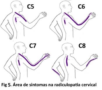 Radiculopatia Cervical