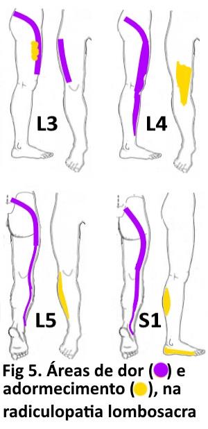 Radiculopatia lombosacra (Dor ciática)