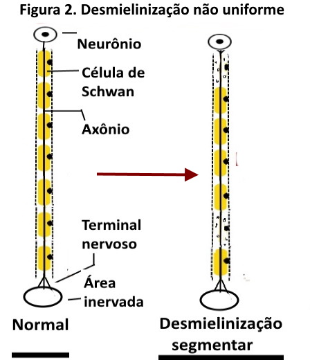 Eletroneuromiografia: Polineuropatia e Neuropatia Multifocal