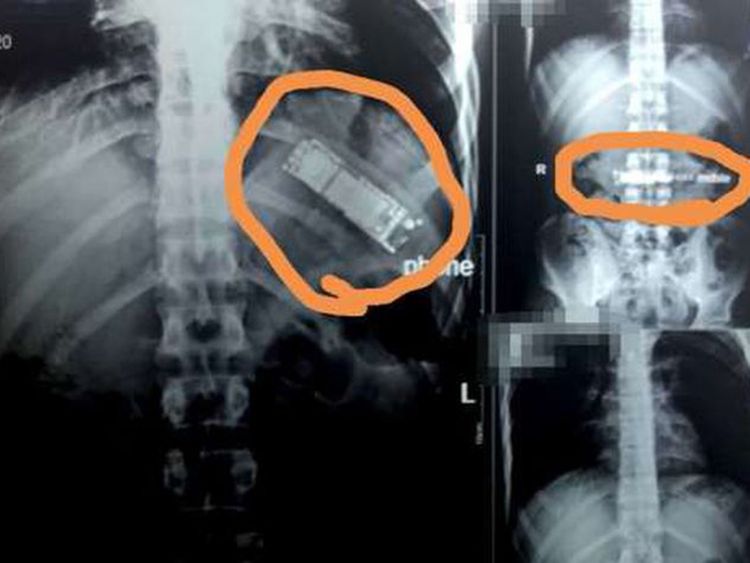 Egípcio passa sete meses com celular no estômago