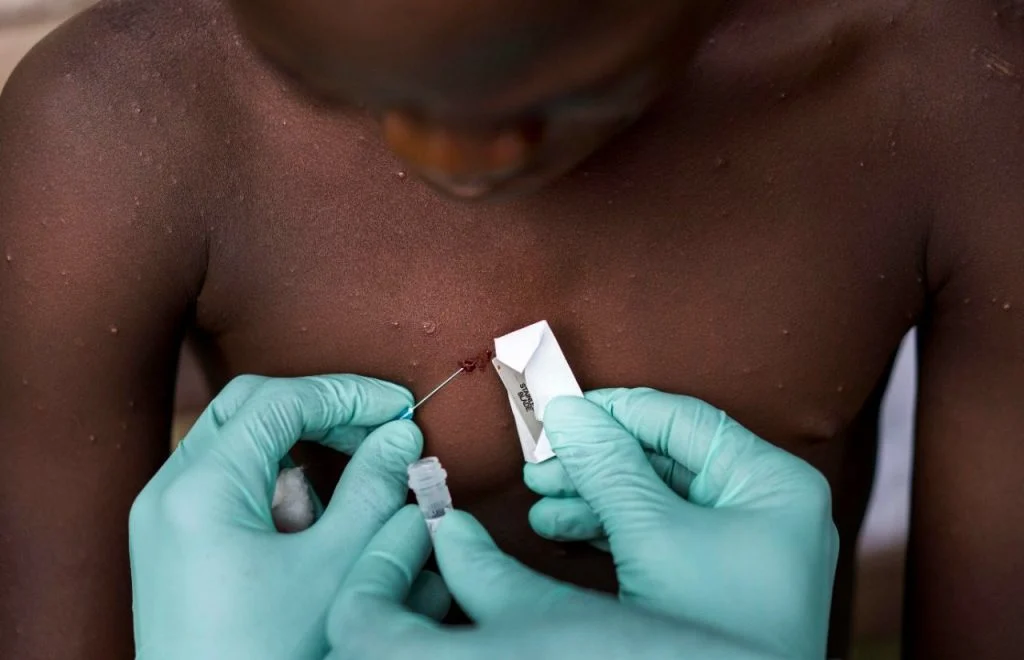 Europa confirma mais 4 casos de varíola do macaco