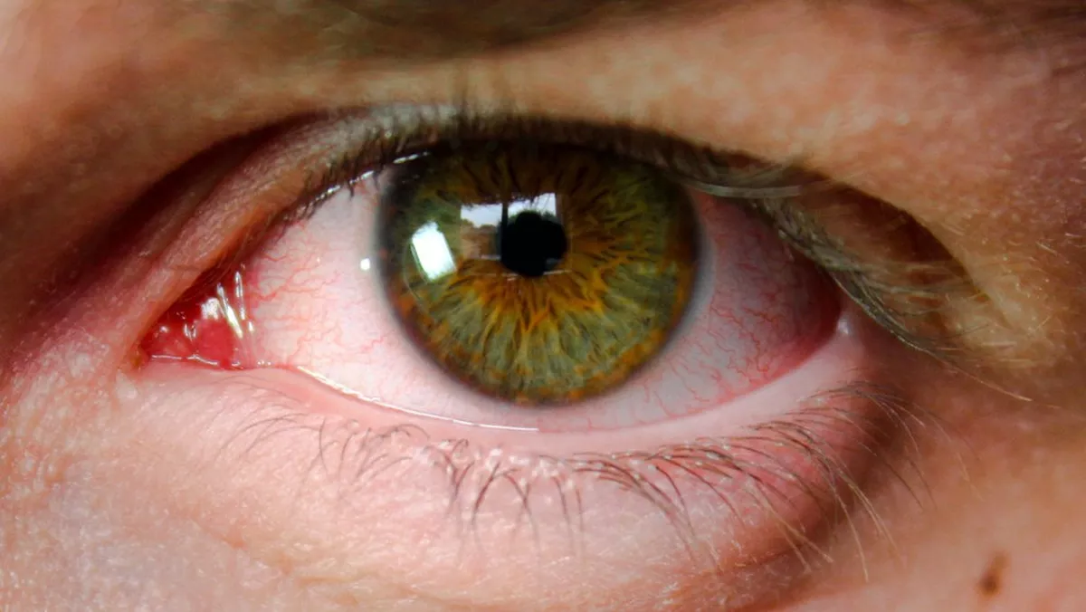 Doença silenciosa: Glaucoma acomete mais de 1 milhão de pessoas no Brasil e 60 milhões no mundo, segundo OMS