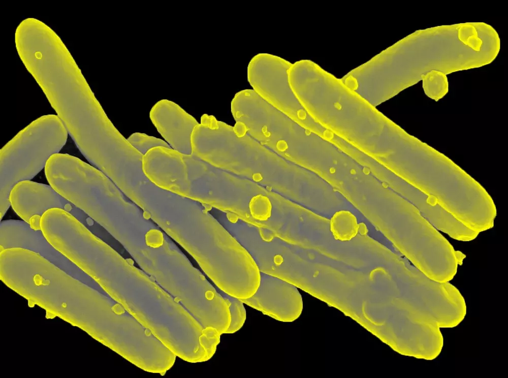 Micobactérias não tuberculosas podem causar sequelas pulmonares irreversíveis