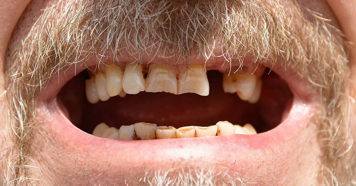 Perda de dentes pode aumentar 28% os riscos de demência. Entenda