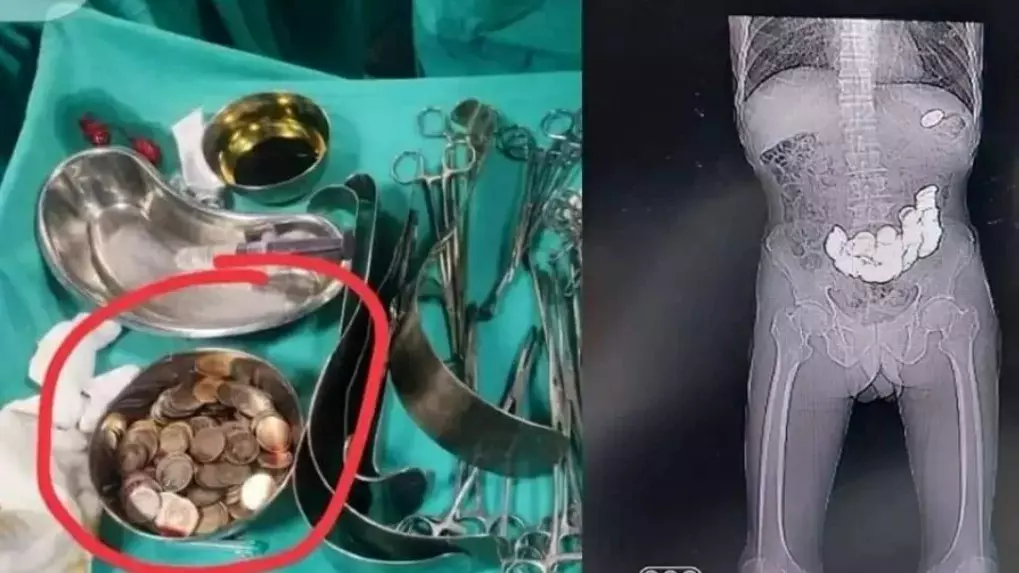Homem passa por cirurgia no estômago após engolir 187 moedas