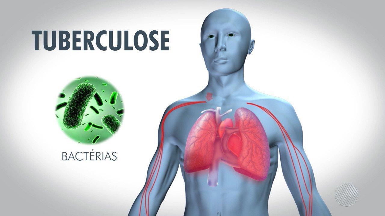 Dia Mundial de Combate à Tuberculose: Ministério da Saúde faz campanha publicitária de alerta sobre a doença