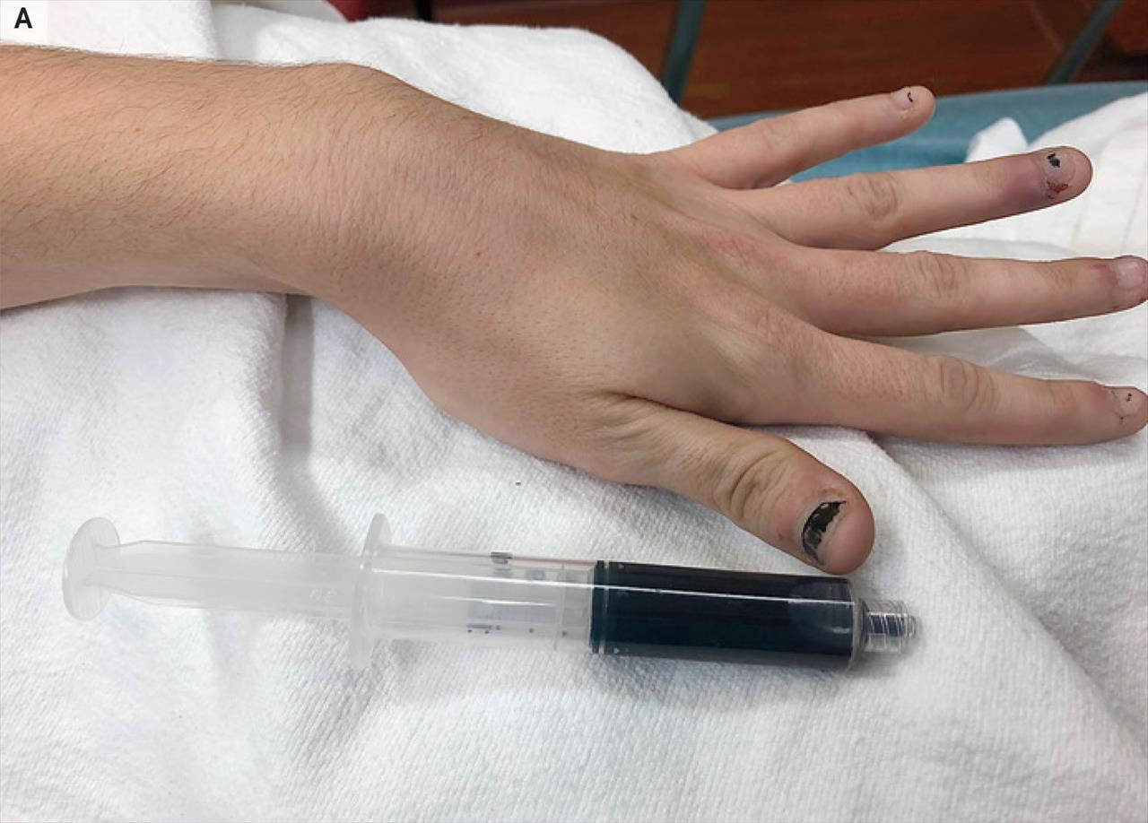 Mulher procura hospital com sangue azul no corpo