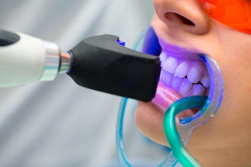 CLAREAMENTO DENTAL LASER