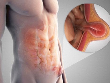 Cirurgia de Hérnia Inguinal, Hérnia Umbilical e Defeitos da Parede Abdominal
