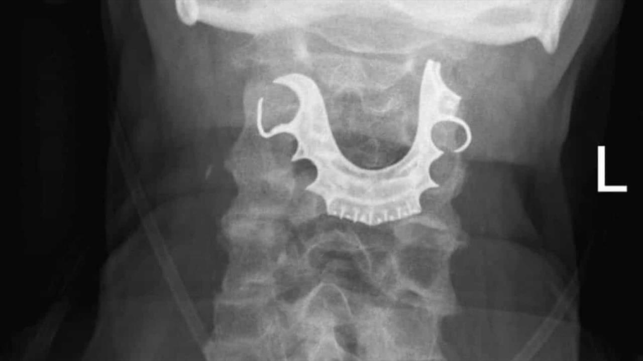 Dentadura perdida ficou presa na garganta durante oito dias