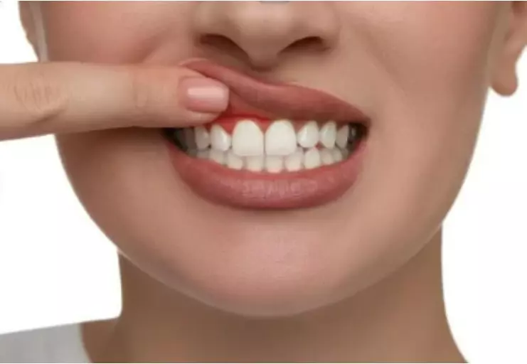 PERIODONTIA – GENGIVOPLASTIA - PEELING GENGIVAL – HALITOSE PERIODONTIA – GENGIVOPLASTIA - PEELING GENGIVAL – HALITOSE