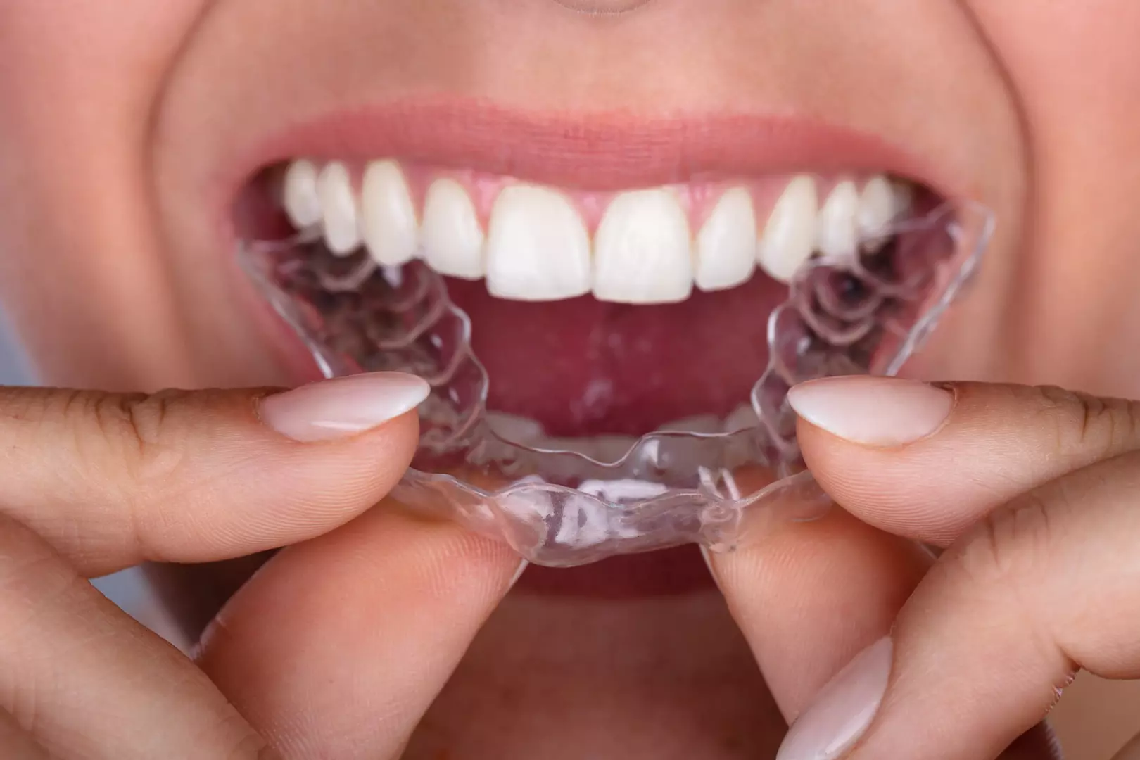 Entenda o que é Invisalign e quais as suas vantagens Entenda o que é Invisalign e quais as suas vantagens
