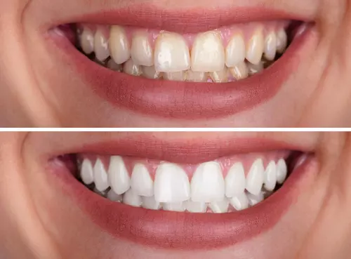 Dentística/Estética